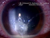 Pseudomonas keratitis demonstrating stromal suppuration with surrounding corneal edema and anterior chamber hypopyon. Patient had a history of extended contact lens wear.